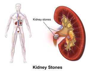 Illustration of Kidney location and Kidney Stones By BruceBlaus. Kidney location and Kidney Stones